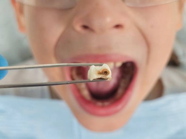 Best Emergency Wisdom Teeth Removal in Doral, FL